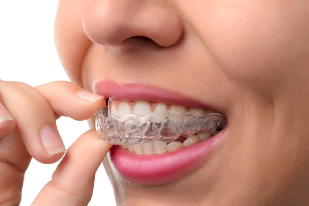 Invisible Braces For Teeth - What and How They Work ?