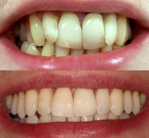 Invisalign for overbite - before and after worst cases