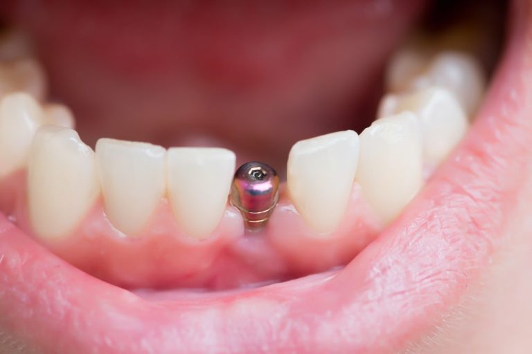 Single tooth dental implants in London