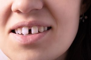 Invisalign for gap in teeth
